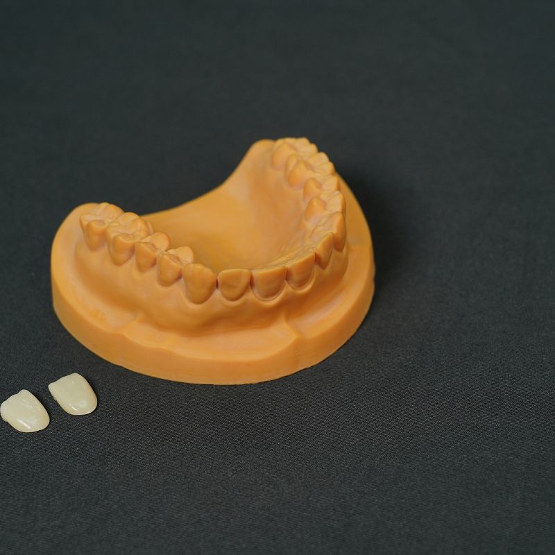 IPS Emax Veneer IPS Emax Veneer